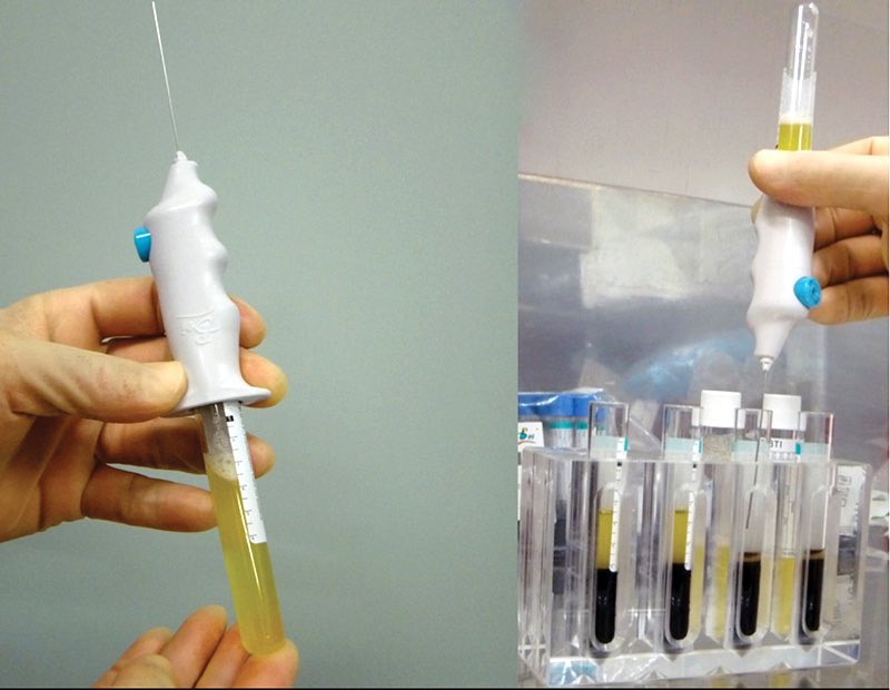 Apa yg Dr akan cdgkan?  Jika anda ahli sukan dan nak tempoh recovery cpt sikit, Dr akan suggest utk Prolotherapy injection (dextrose) atau selepas subacute tempoh radang, Dr akan suggest utk PRP (Platelet Rich Plasma). Basically prp ni akan regenerate muscle kita 