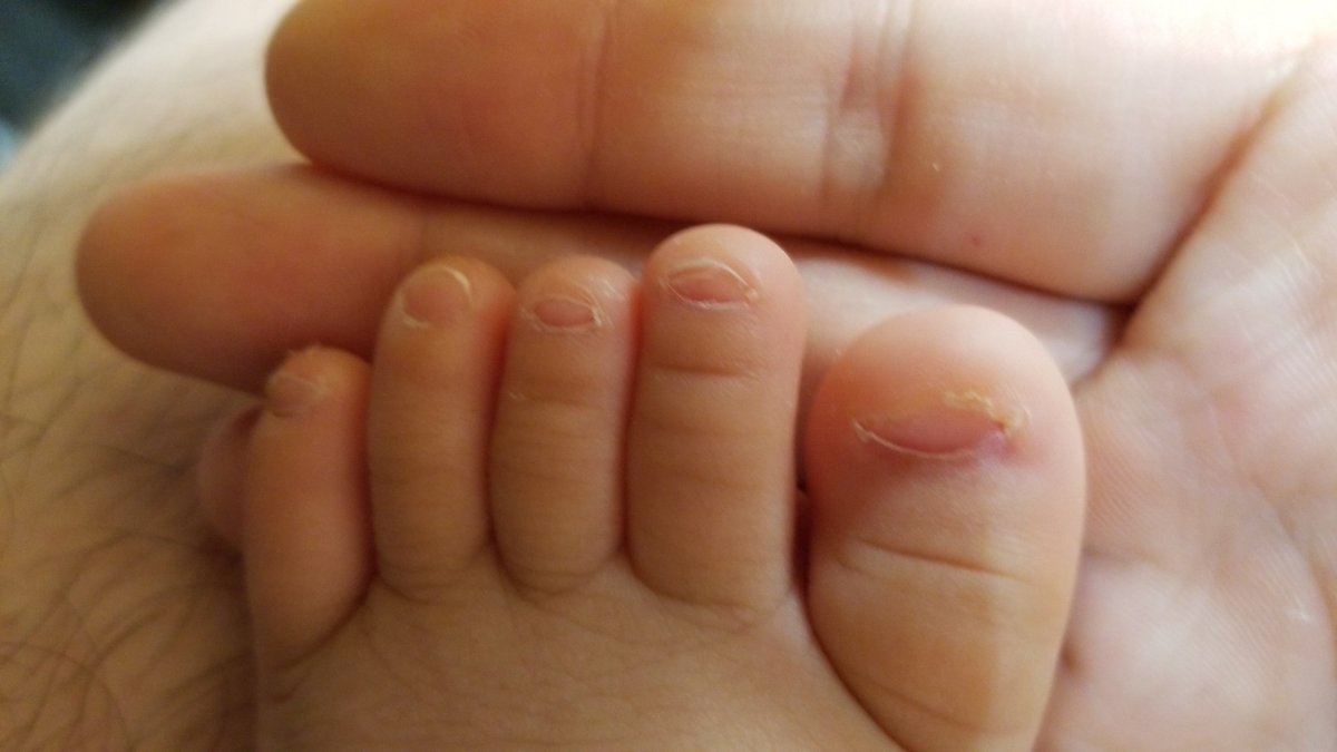 こじmax 1y11m 2m うちの子は両足とも足の中指が人差し指と薬指より短い変わった足をしているのですが 他に変わった足をしている子を持ったお父さんお母さんいらっしゃいますかね