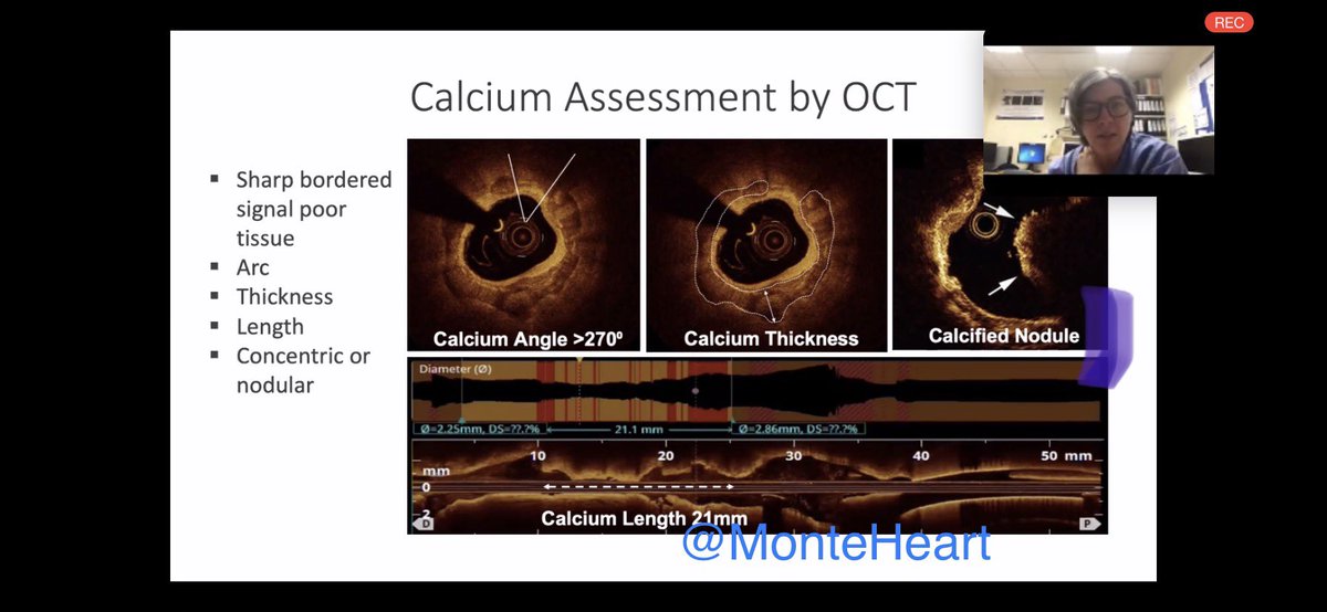 MonteHeart's tweet photo. 1/
Dr. @mbmcentegart breaking down the assessment of Calcified Coronary Lesions (CCL)
▪️First- assess CCL morphology. 
▪️OCT, when compared to IVUS, allows assessment of thickness of CCL. https://t.co/JMn7jvqhDY