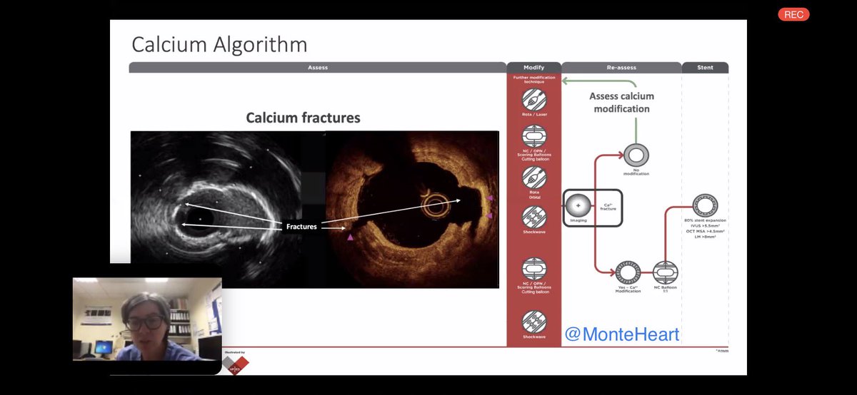 MonteHeart's tweet photo. 2/
Excellent algorithms to save the day! 
▪️When assessing morphology, pay attn. to arc, thickness, length and modularity of CCL. 
▪️Proceed along appropriate arm of algorithm. 
▪️after initial attempt at modification, assess to see if modified at all! Then proceed accordingly.. https://t.co/sa7YPMtmVT
