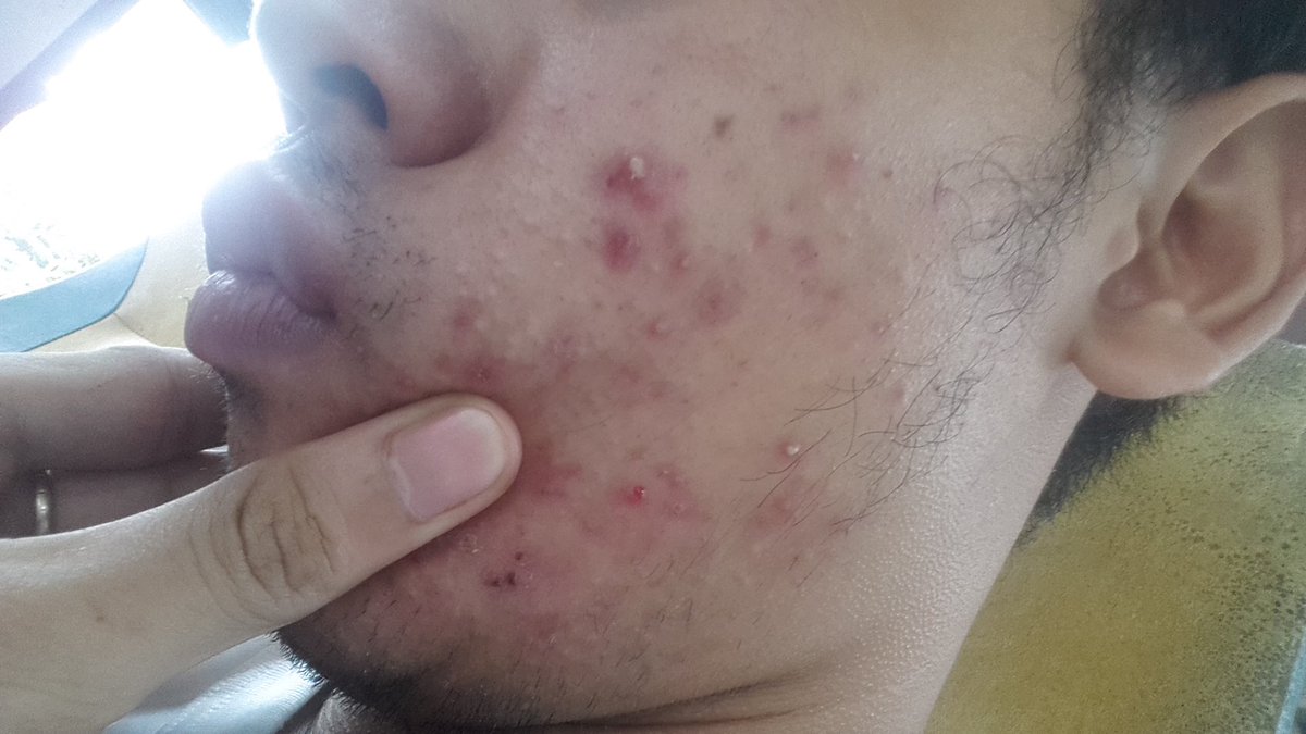 After getting examined, the doctor told me that my breakout was due to the fact that I stopped using moisturizers. FYI, I was 22 at that time, I’ve been using moisturizers since I was 18. I was told I shouldn’t have used moisturizers at that age. I was advised to stop.