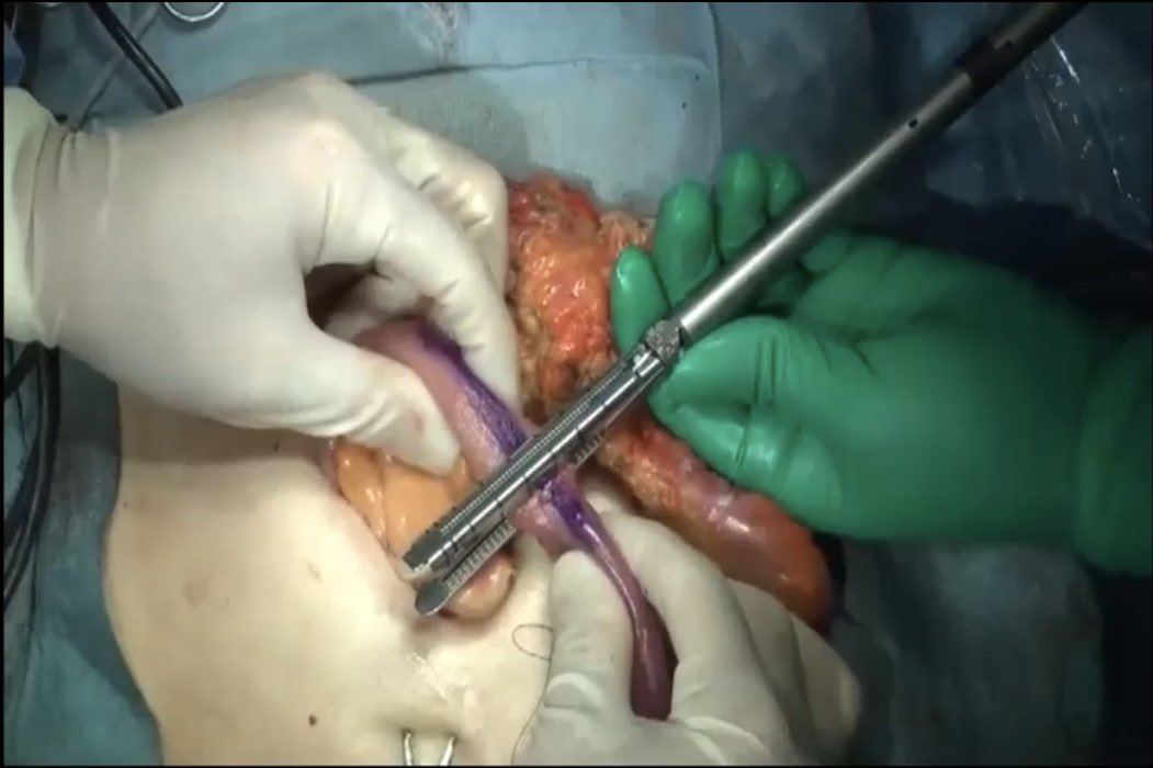 AforDHAHRI's tweet photo. #KonoS Anastomosis
Good video demonstration
Great learning
#Bridge
#Lembert anastomosis
Need to test #LearningCurve
Thank you @Dukes_Club https://t.co/xRUdGxiWcs