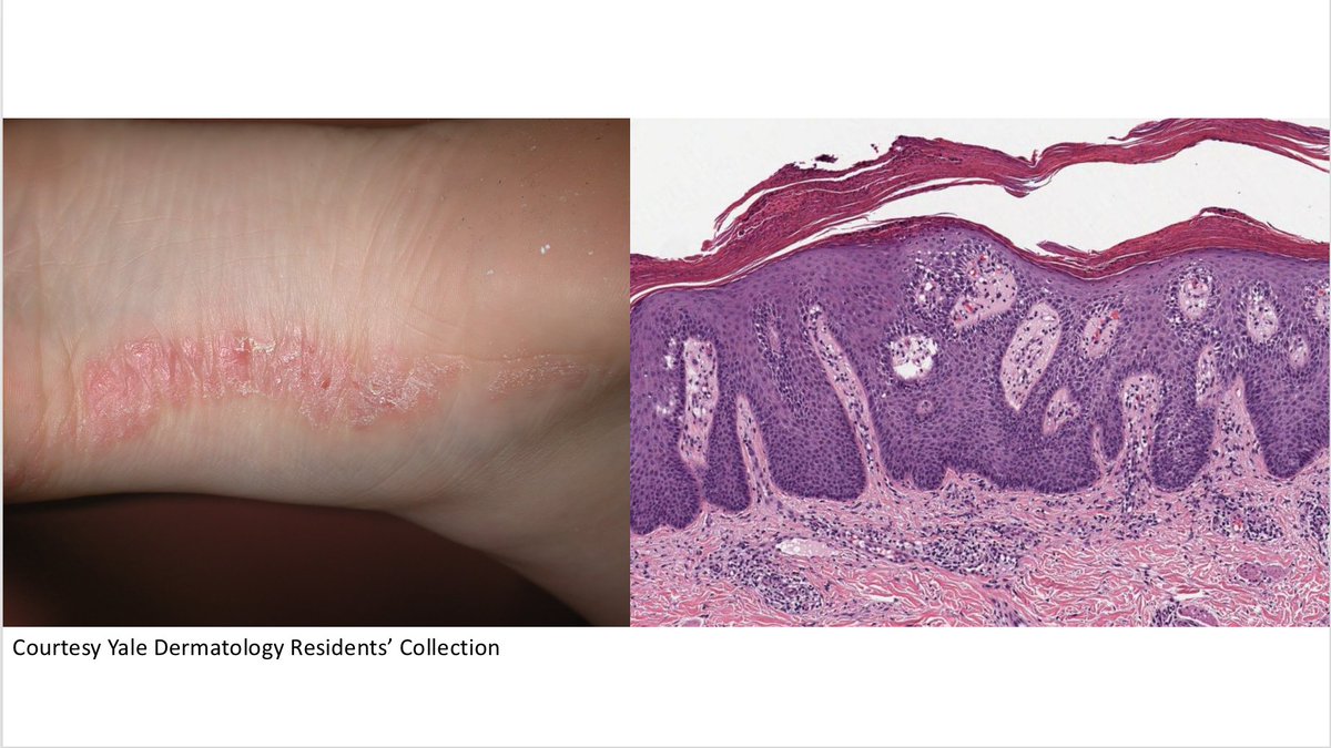 ChristineJKoMD's tweet photo. What's your diagnosis for this linear lesion on the arm? Short #clinpathcorrelation video answer at 
https://t.co/4wWBNEiLGT #cpKo #Dermatology https://t.co/GIeJxk8uwQ