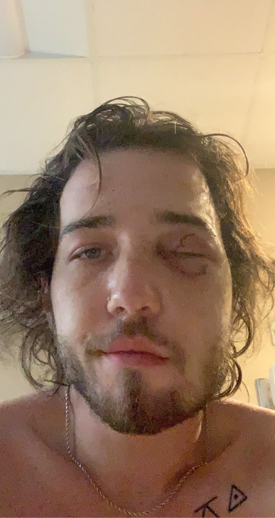 100 days ago my eye was removed by surgeons after being ruptured beyond repair by the Fort Wayne Police Department’s militarized attack on its peaceful protesters.