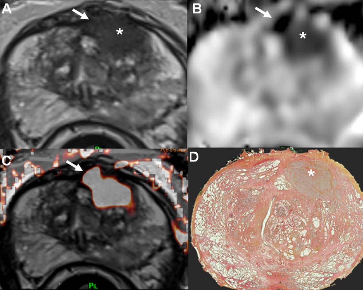 OleaMedical's tweet photo. The 1st International Workshop on #MRI of #Prostate, organized by Dr. @CornudF, will be held on September 24-25, 2020. This intensive 6-hours on-line workshop will combine short oral presentations and presentation of 25 clinical cases. 
📌 Register now: https://t.co/osQTTwfw5h https://t.co/jCWB9mhas6