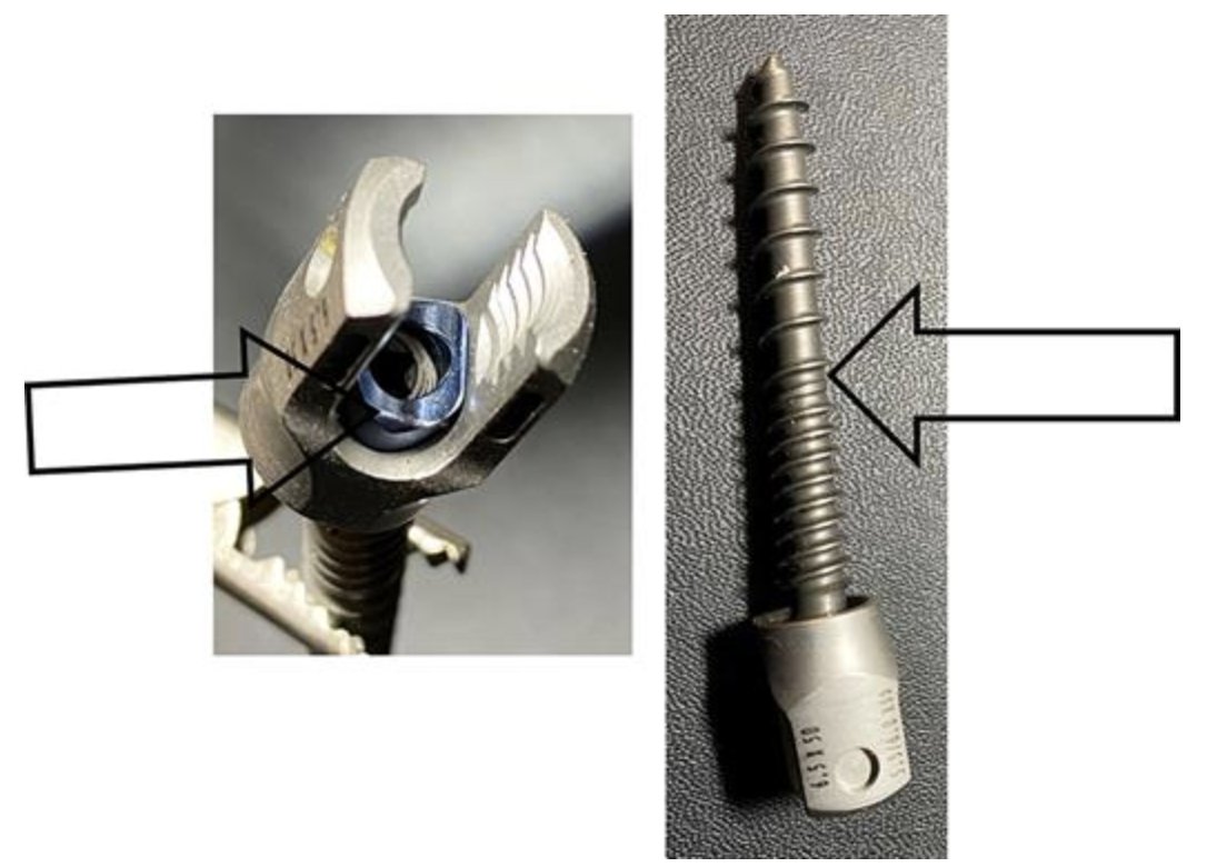 NeurosurgeryCNS's tweet image. #ONSAdvanceAccess Do pedicle screw resistances affect triggered Electromyography? Find out in in this paper by Norton et al @SaskHealth ow.ly/svkA30r8KiE #EMGtesting, #PedicleScrew #Spineinstrumentation #Neurotrauma