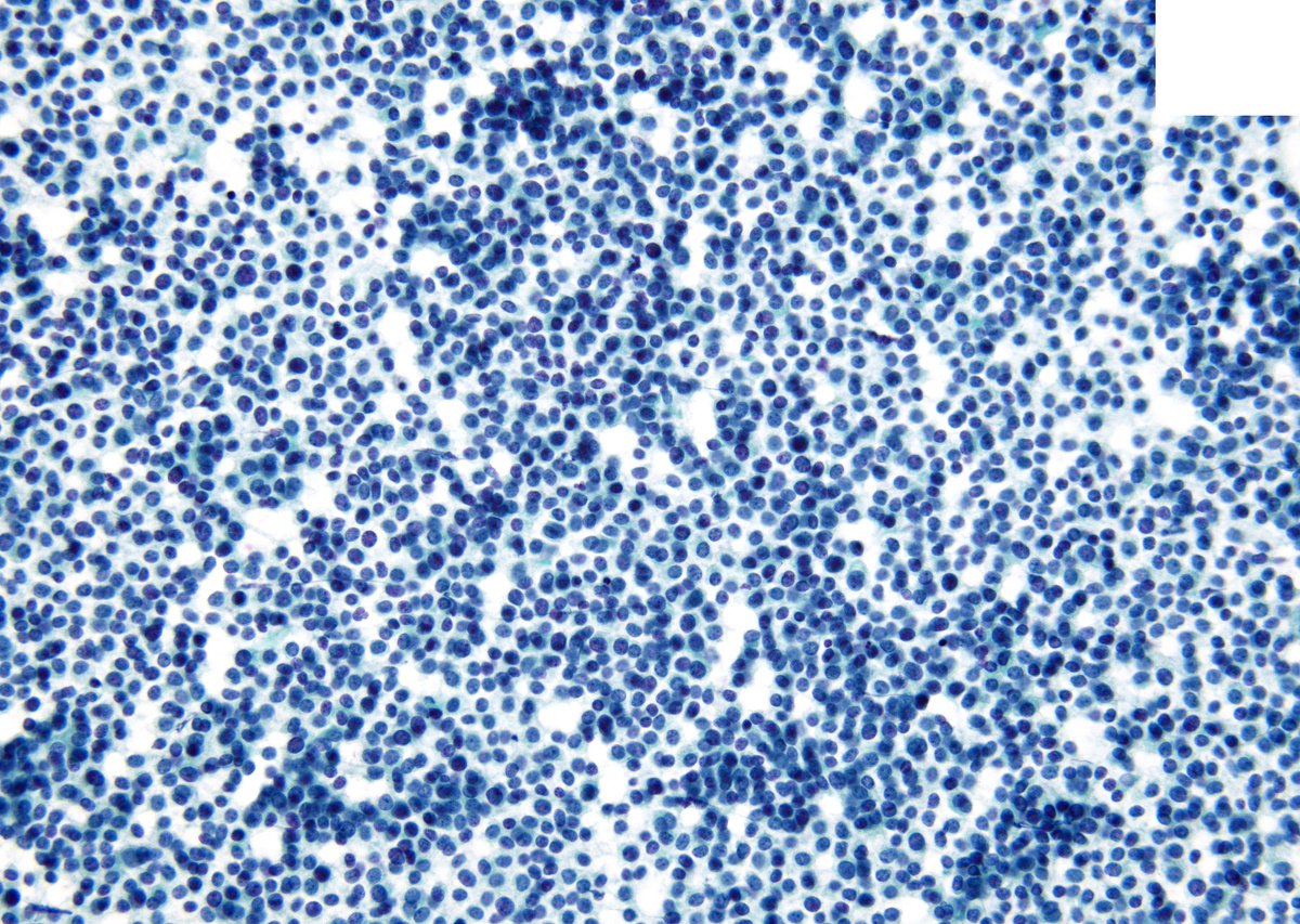 sza_jhcyto's tweet photo. A common IMPERILMENT in Pancreatic Cytopathology is the distinction of a Neuroendocrine Tumor (PanNET) from an Acinar Cell CA (ACC) and vice versa due to significant cytomorphologic overlap. Do not be disappointed if I tell you that this turned out to be an ACC on IHCs. https://t.co/icfbCjrsUD