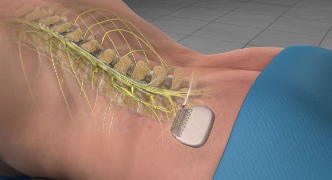 FNeirami's tweet photo. Spinal cord stimulation (also called SCS) uses electrical impulses to relieve chronic pain of the back, arms and legs. It is believed that electrical pulses prevent pain signals from being received by the brain. 

 #implant #pain #backpain #spine #lowerbackpain #painrelief https://t.co/P91kva60TC
