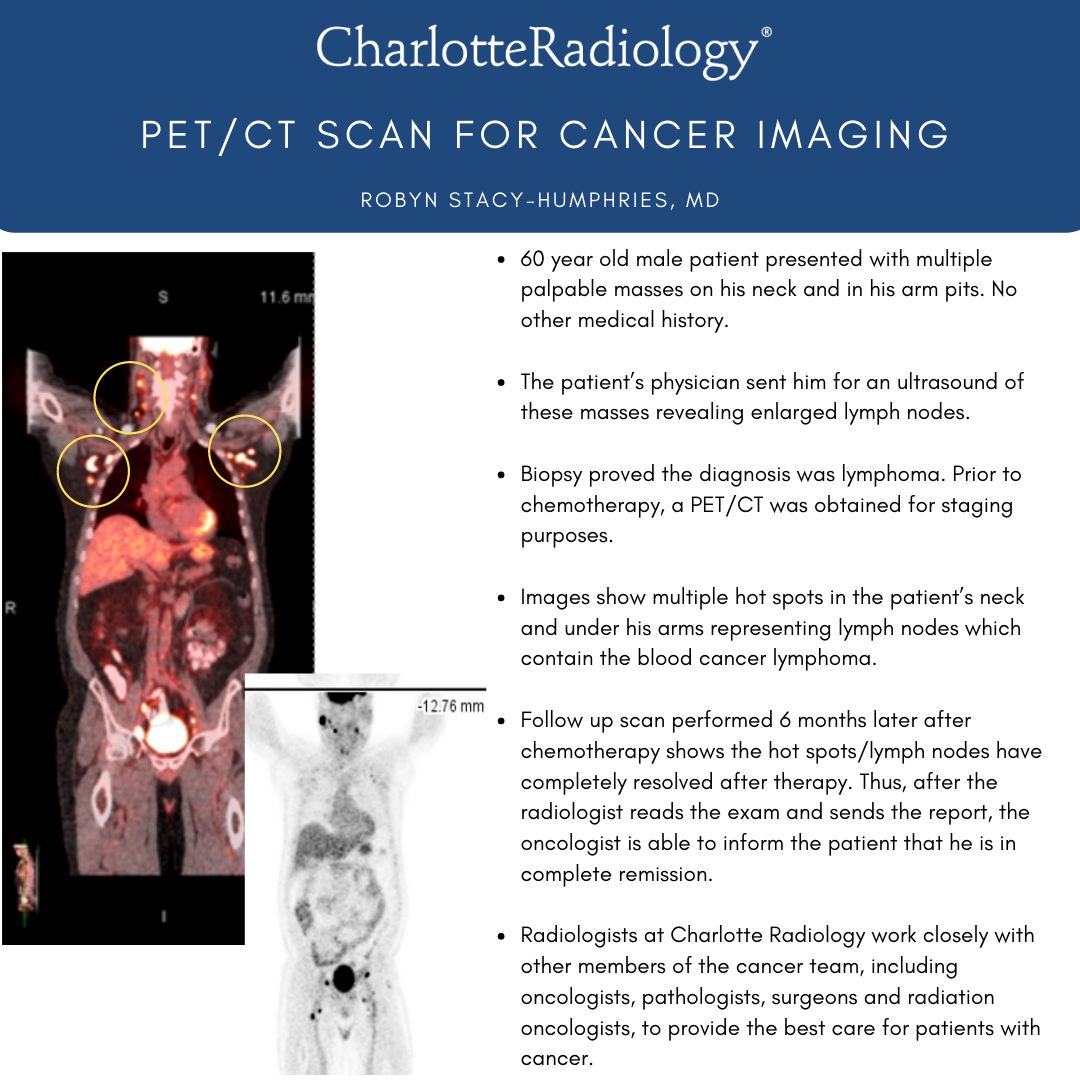 CLTRadiology's tweet photo. Did you know that radiologists at Charlotte Radiology work closely with other members of the cancer team, including oncologists, pathologists, surgeons, and radiation oncologists? This #CaseStudyTuesday, @Dr_Robyn shares how a PET/CT scan can be used for #cancer #imaging. https://t.co/gn023ByHgv