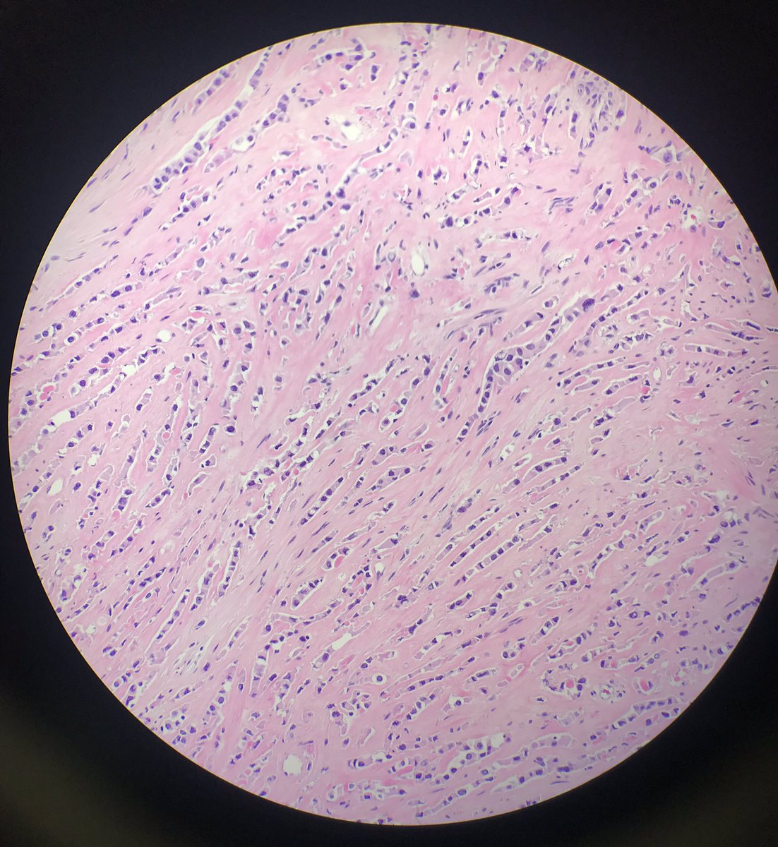 JBrowningMD's tweet photo. Sclerosing epithelioid fibrosarcoma in a kidney! + MUC4. Histologically low grade. Clinically aggressive. #BSTpath #GUpath https://t.co/jKKWPjlLqW