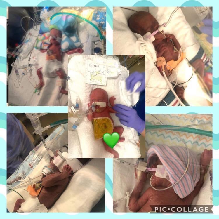 AMWK_22's tweet photo. I was born at 22 weeks 0 days. 

I weighed 13 ounces and was 11 inches long. 

I was given a 0% chance of survival once my mommy’s water broke at 18.5 weeks and again when I went septic at 2 weeks old. 

I’m 33 weeks adjusted/11 weeks actual today. https://t.co/inIiaEmV91