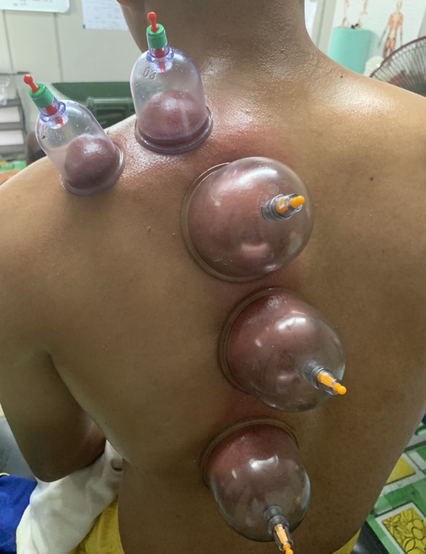 Cara cara utk mencegah kecederaan hamstring?cupping stretchingproper & sufficient stretching (check balik btl ke kita stretch tu hamstring)klu rasa tight boleh letak minyak panas/hot pack dan massagekinesiotapeelastic bandage/adhesive bandagestrengthening