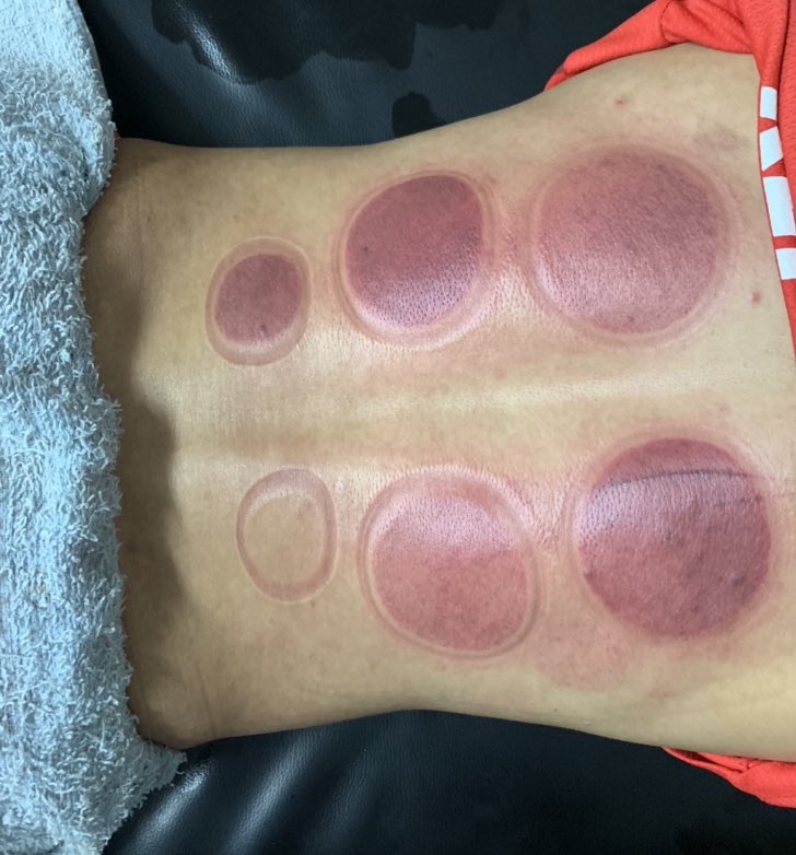 Cara cara utk mencegah kecederaan hamstring?cupping stretchingproper & sufficient stretching (check balik btl ke kita stretch tu hamstring)klu rasa tight boleh letak minyak panas/hot pack dan massagekinesiotapeelastic bandage/adhesive bandagestrengthening