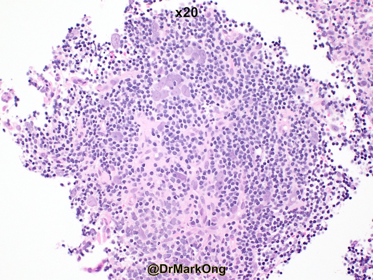 Adult with enlarged level III lymph node. I failed miserably to make a diagnosis on this core biopsy. 🙄 I suspected the final diagnosis, but was let down by the IHC (that's my excuse, anyway). As usual, what are the differentials and what IHC would you want to see? #hemepath