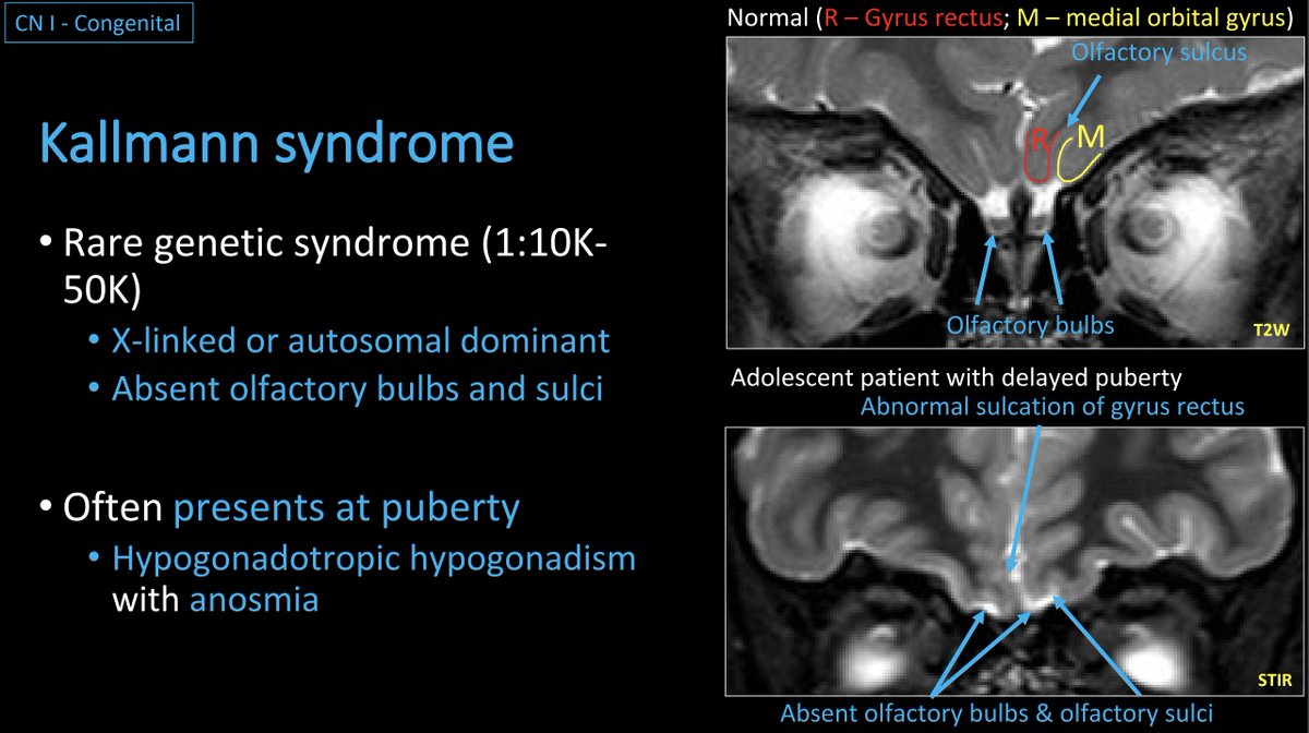 WmOBrienDO's tweet photo. #ASHNR20: #GreatEE (EE204) from Jennifer Huang, et al. titled 'A Little Nervous: A Review of Pediatric Cranial Nerve Anatomy &amp; Disorders.' Beautiful illustrations incl congenital, acquired &amp; neoplastic pathology affecting CNs. Some ex educational cases below:
@ASHNRSociety
#HNRad https://t.co/GRIwYbCMuv