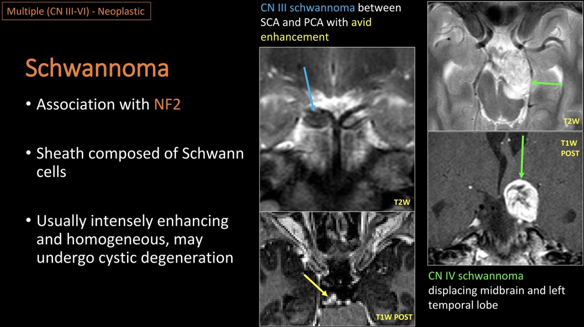 WmOBrienDO's tweet photo. #ASHNR20: #GreatEE (EE204) from Jennifer Huang, et al. titled 'A Little Nervous: A Review of Pediatric Cranial Nerve Anatomy &amp; Disorders.' Beautiful illustrations incl congenital, acquired &amp; neoplastic pathology affecting CNs. Some ex educational cases below:
@ASHNRSociety
#HNRad https://t.co/GRIwYbCMuv