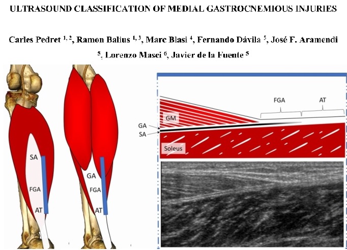 Revolutionising how we classify (and approach?) medial gastrocnemius injuries? 

Kudos to this international author group (led by Dr Carles Pedret) for this practical contribution #CalfInjuries 👏 <a href="/carlespedret/">carlespedret</a> &amp; co

onlinelibrary.wiley.com/doi/abs/10.111…