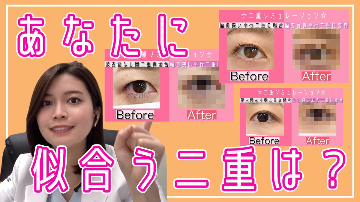 埋没法二重術