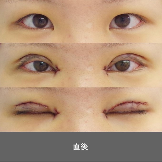 全切開二重術 全切開二重術