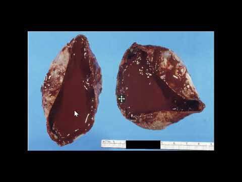 When they're found in the ovaries it's called Endometrioma/Chocolate cyst.About 5-10% of young women have one form of endometriosis.Cause is unknown for now but back flow of menstrual blood through the fallopian tubes is the most common accepted theory. This is why some