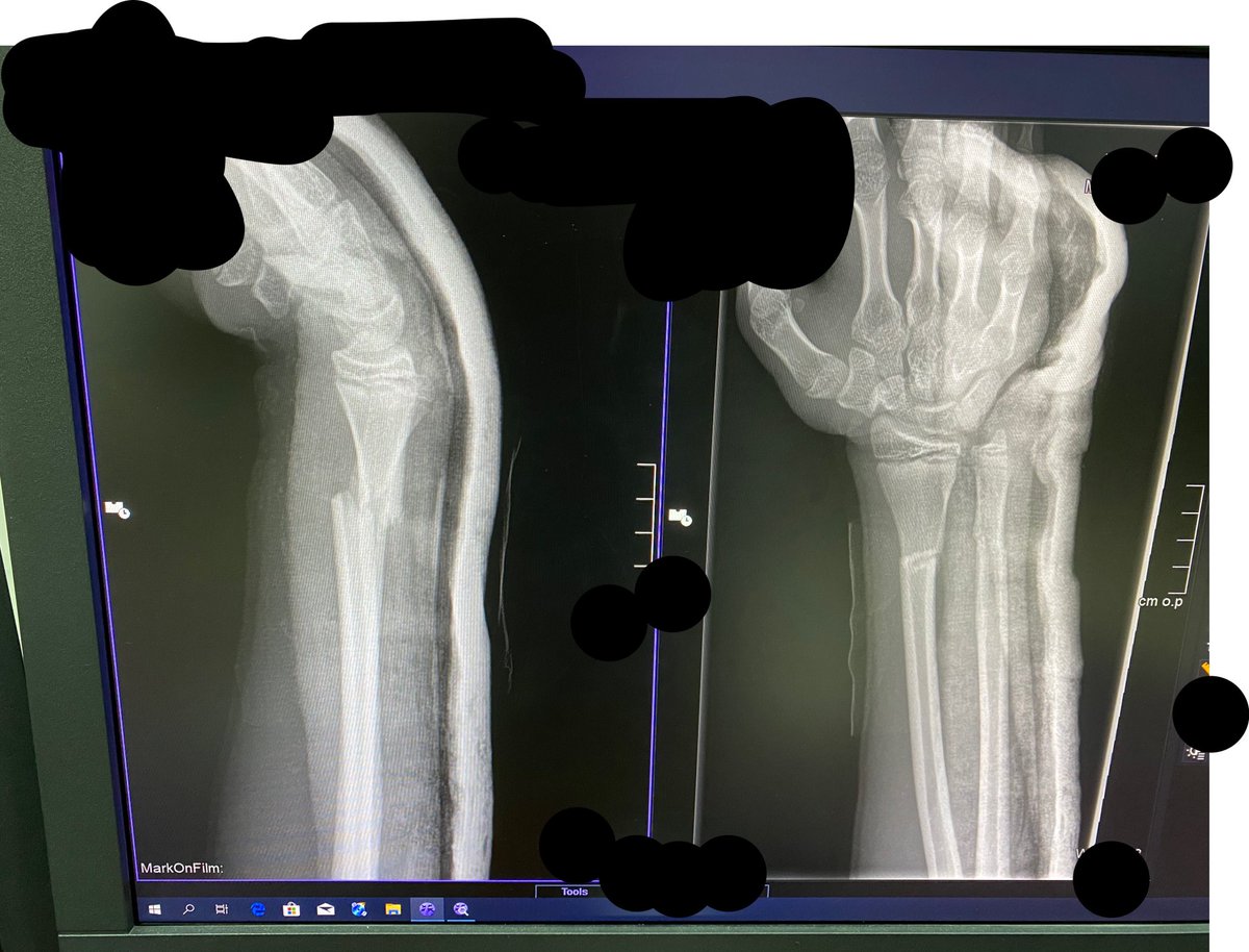 #OrthoTwitter  13y/o Fall on outstretched hand. N/V intact. Acceptable reduction? What would you do? 

<a href="/mymomthesurgeon/">Jennifer Weiss</a>