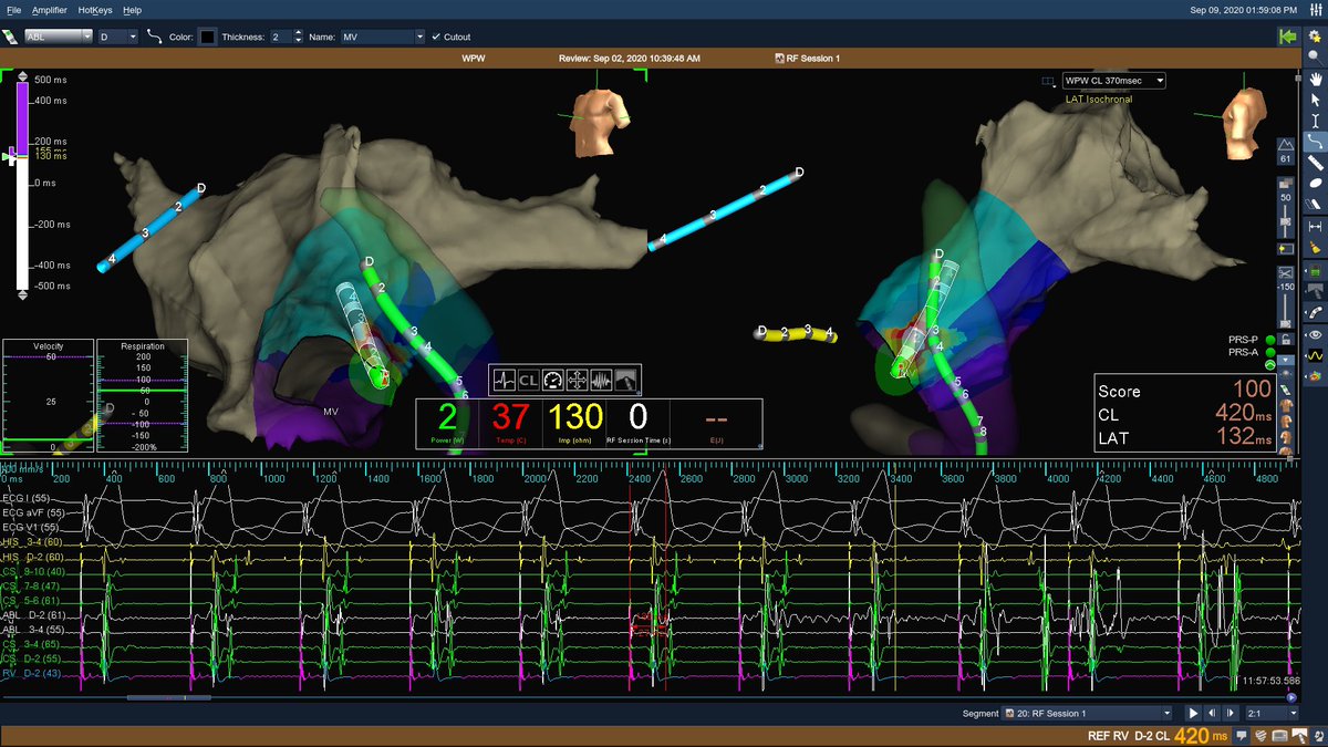 MicheleB_MD's tweet photo. The fastest #AP I have ever done in my career. After successful #TSP inferoposterior of an Amplatzer PFO occluder #fluorofree mapping & #RF > 1 beat (~380msec) & gone for ever. #electrophysiology at its best. @EPeeps_Bot @AbbottCardio #arrhythmia #accessorypathway https://t.co/5y1Rc2SZUe