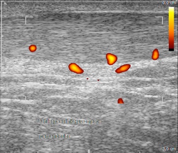 2/Neovascularisation and adjacent nerve infiltration in/around the Achilles tendon is of increasing interest, as this is usually seen in patients with tendinopathy and mostly absent in healthy tendons. Neovessels are suggested to play a role in the chronicity of symptoms.
