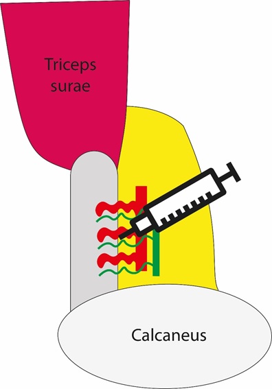 3/So how could neovessels be used for therapeutic interventions? A novel conservative treatment option is a high volume injection (HVI), which aims to destruct this neovascularisation and adjacent nervesthrough high mechanical pressure.