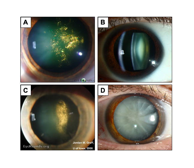 See if you can answer this week's matching question with beautiful cataract images courtesy of <a href="/EyeRounds/">EyeRounds</a> <a href="/uiowaeye/">UIowa Eye</a>! Options are: NS, cortical, PSC, and🎄

#Ophthalmology #MedTwitter #Cataracts