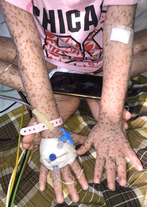 agungmrheza's tweet photo. TWITTER PLEASE DO YOUR MAGIC 🙏

Adik Mutia Lasifa adalah salah satu pasien saya di RSCM yang sedang mengidap penyakit langka Eritroderma dan saat ini membutuhkan banyak biaya untuk pemeriksaan diagnostik, terapeutik, dan kehidupan sehari-harinya (foto seizin orang tua pasien) https://t.co/mhkI8D4Rik