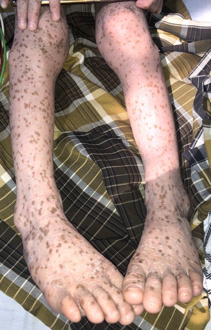 agungmrheza's tweet photo. TWITTER PLEASE DO YOUR MAGIC 🙏

Adik Mutia Lasifa adalah salah satu pasien saya di RSCM yang sedang mengidap penyakit langka Eritroderma dan saat ini membutuhkan banyak biaya untuk pemeriksaan diagnostik, terapeutik, dan kehidupan sehari-harinya (foto seizin orang tua pasien) https://t.co/mhkI8D4Rik