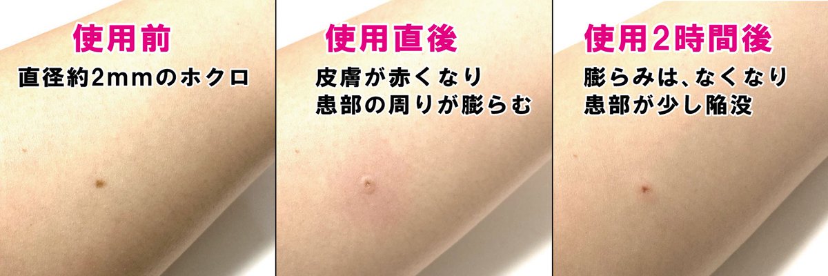 ミリ フォロワーさんのツイートで教えていただいた ホクロ 除去ペン が届いたので試してみました 今回は ホクロ と 赤いホクロ 血管腫 に試してみたのですが また経過をレポートしていきたいと思います 10週間かけて傷が完治するそうです ミリ フォロワーさんのツイートで教えていただいた ホクロ 除去ペン が届いたので試してみました 今回は ホクロ と 赤いホクロ 血管腫 に試してみたのですが また経過をレポートしていきたいと思います 10週間かけて傷が完治するそうです
