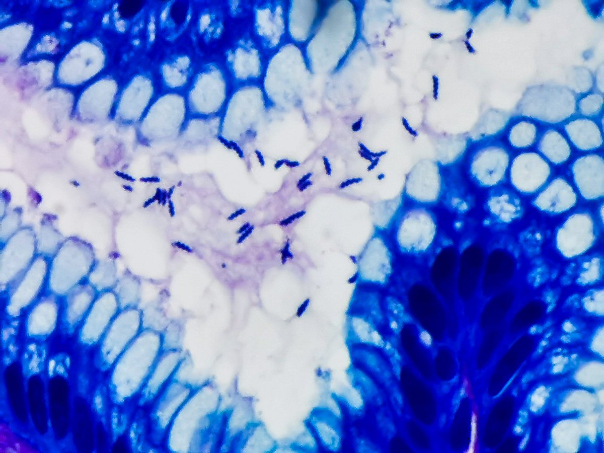 LuizMiguelN's tweet photo. 🔬😍 Helicobacter Heilmannii 😍🔬

✏ Long tight spirals.
✏ Thicker and twice as long as H. pylori.
(Giemsa stain) 
#Pathologist #GIPath #pathResidents #Pathology https://t.co/gSopEw8y2q