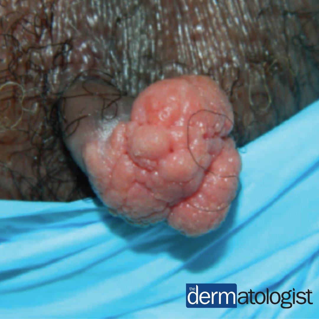 TheDermEditor's tweet photo. This 66yo Pt presented with a 1.5cm x 1cm, pink, exophytic nodule that was pedunculated and progressively enlarging. He reported no other skin complaints and no history of skin cancer. What's the #DermDx? Check your answer: https://t.co/ZLoWdqL4aR #dermtwitter https://t.co/ruUTdO5UWw