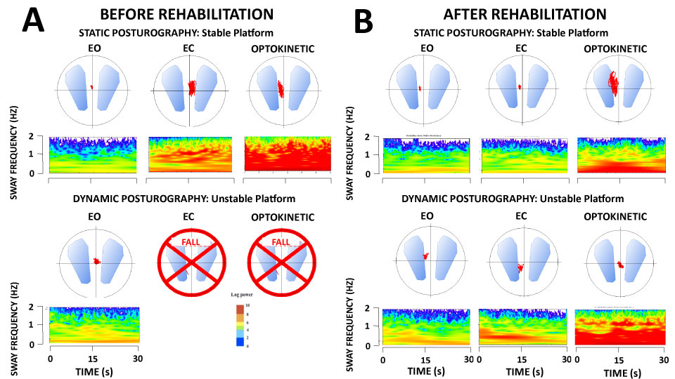 Latest Publication
Rehabilitation of balance control with the rotatory chair protocol depends on rehabilitation onset and postural task difficulty in unilateral vestibular hypofunction patients
rehabiljournal.com/articles/rehab…
Michel Lacour, Laurent Tardivet, Alain Thiry

#vestibularrehab