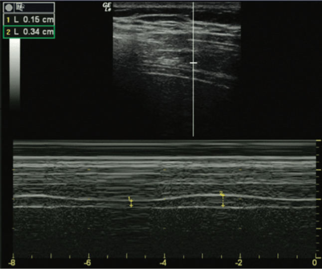 A diaphragmatic thickening fraction <30% (with a range of 24%–35% in most studies) is considered abnormal. The figure below shows normal diaphragmatic thickening fraction using M-mode.