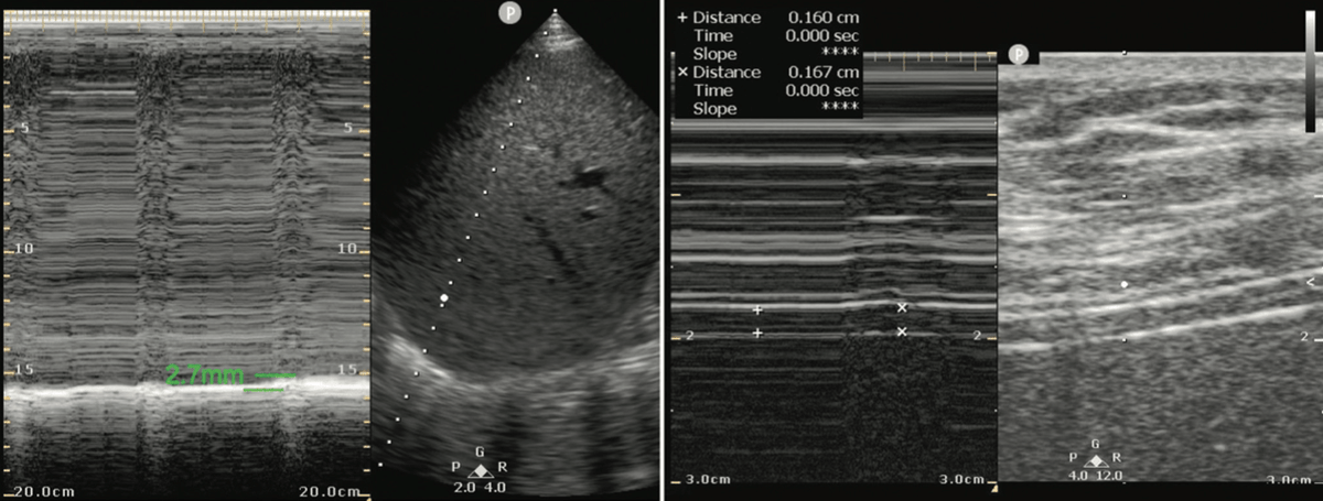 Your 89-year-old female patient is improving after her initial admission to the ICU for respiratory failure due to pneumonia. She is alert and normotensive and signals her desire to be removed from the ventilator. On her spontaneous breathing trial, you perform this thoracic US: