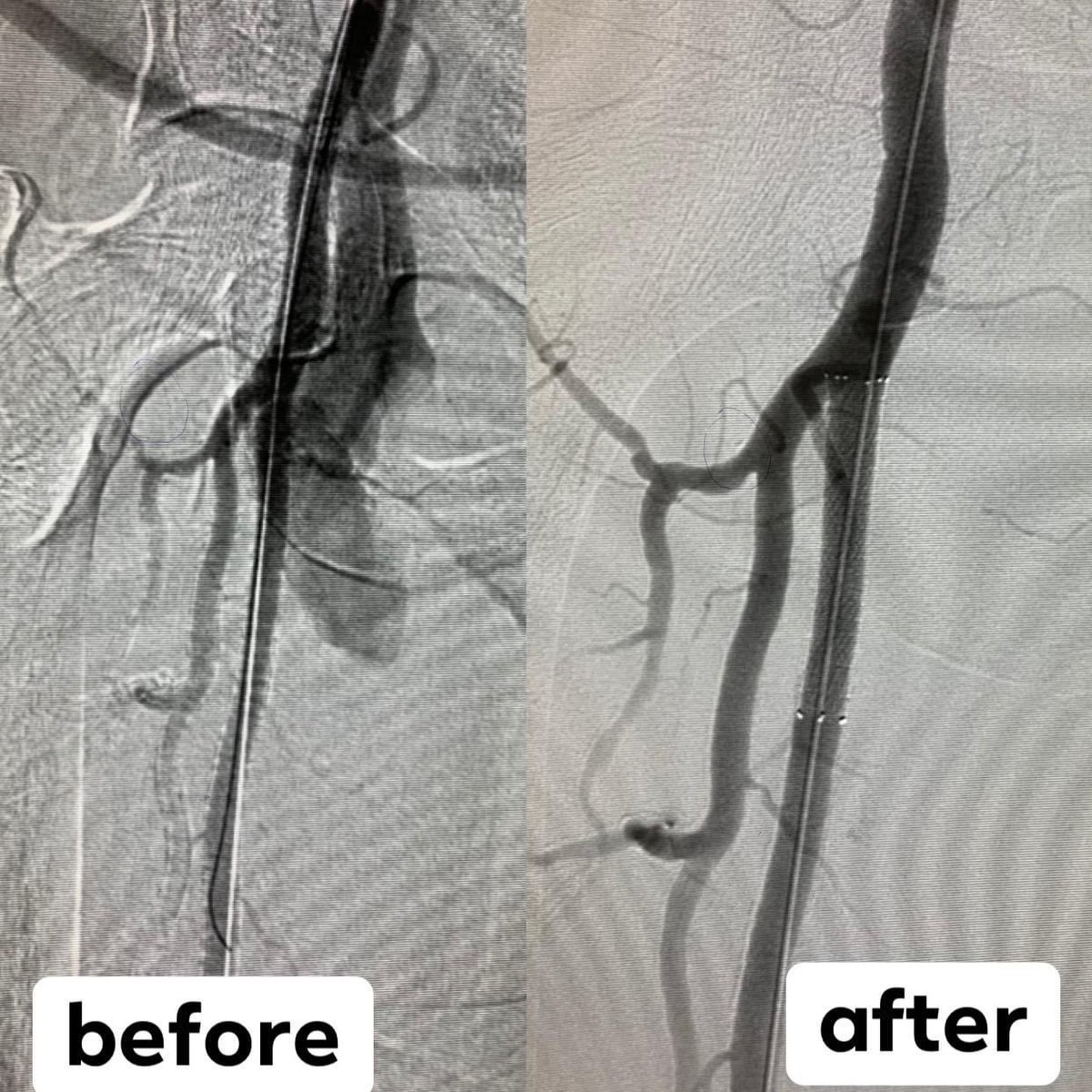 nashwan111976's tweet image. Case made my day  ,2 birds has been hit by one stone in 2 minutes 
Traumatic Arteriovenous fistula  with pseudoaneurysm During dialysis catheter insertion trail treated by stent graft covera plus 7mmx 40mm  #Bard #proglide#minimalinvasive  #localanasthesia #esrd
#kfmc