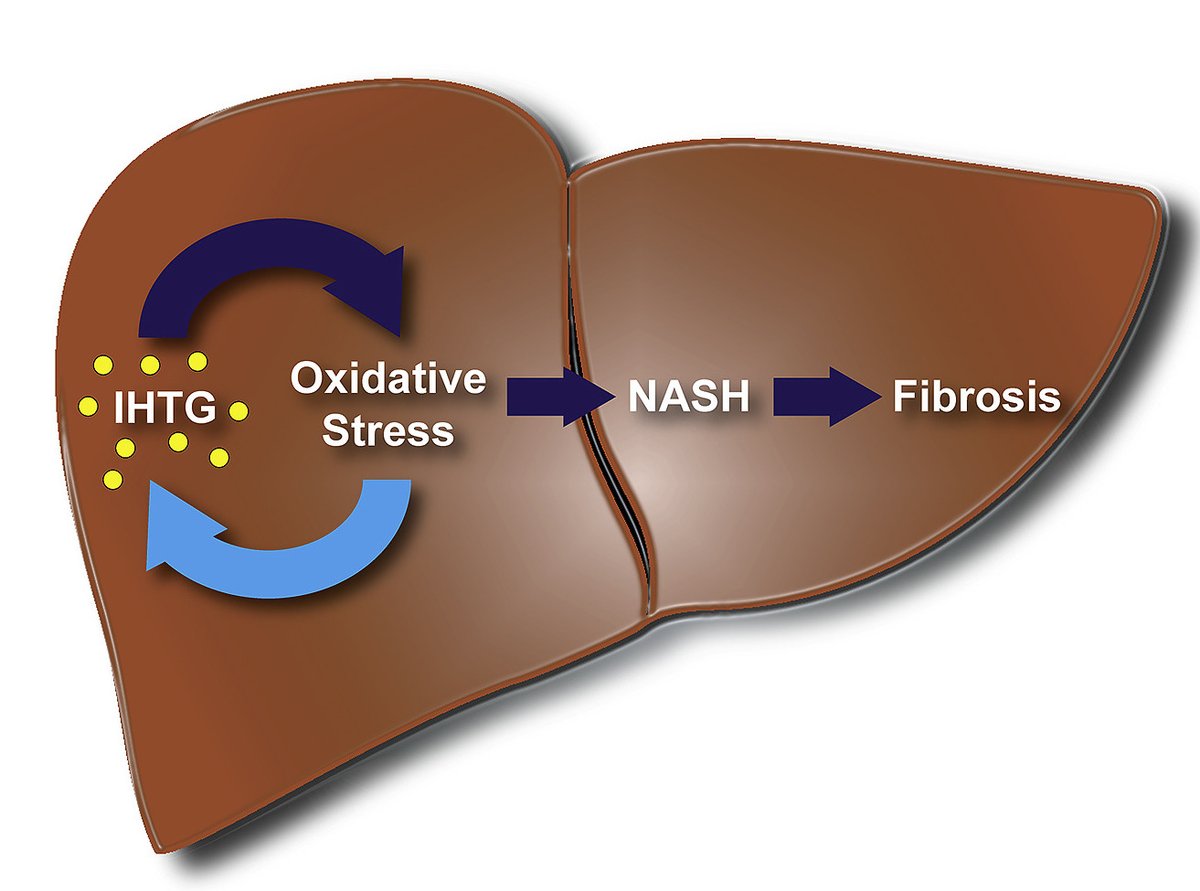 NASH_and_coffee's tweet photo. New paper from @MC_Podszun at @NIDDKgov #RotmanLab in Redox Biology - we used #VitaminE to uncover a pathway leading from #OxidativeStress to de novo lipogenesis (DNL) and #Steatosis
Let's try a #TwitterAbstract
#LiverTwitter #NAFLD #NASH #NAFLDsig (1)
https://t.co/rUVFwirNp8 https://t.co/TuYDkb0s7U