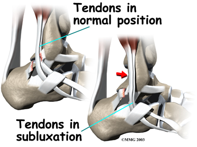 Okay but seriously what is it? The peroneal muscles actively pull your foot outwards. When the foot sharply turns in combined with dorsiflexion the tendon sheath (retinaculum) can rupture and the tendon will dislocate, tear and move forward. Dislocation anatomy:
