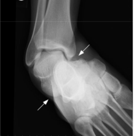 What about his ankle? It's not uncommon for a peroneal tendon dislocation to be associated with an ankle dislocation, where essentially the tibia slips off the talus. This puts significant pressure on the lateral ankle where the peroneal tendons sit. Xray of dislocation: