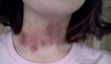 Je pense que ma fille a eu un accident de voiture hier soir...
Elle est remplie de bleus autour du cou c’est vraiment bizarre, pourquoi ne m’a-t-elle rien dit??