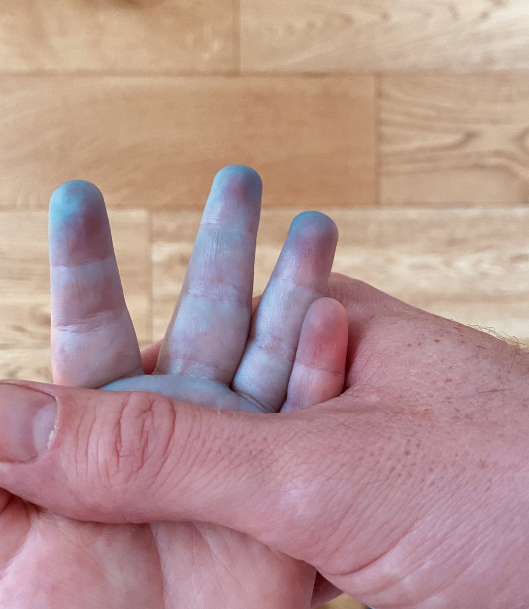 robfenwick's tweet photo. 2 year old male. 

Systemically well. Currently teething. Slight rhinorrhoea. Isolated discolouration to 3 fingers. 

Hit me with your differentials twitter........

(Image posted with permission of parent) https://t.co/NOxB4FW94y
