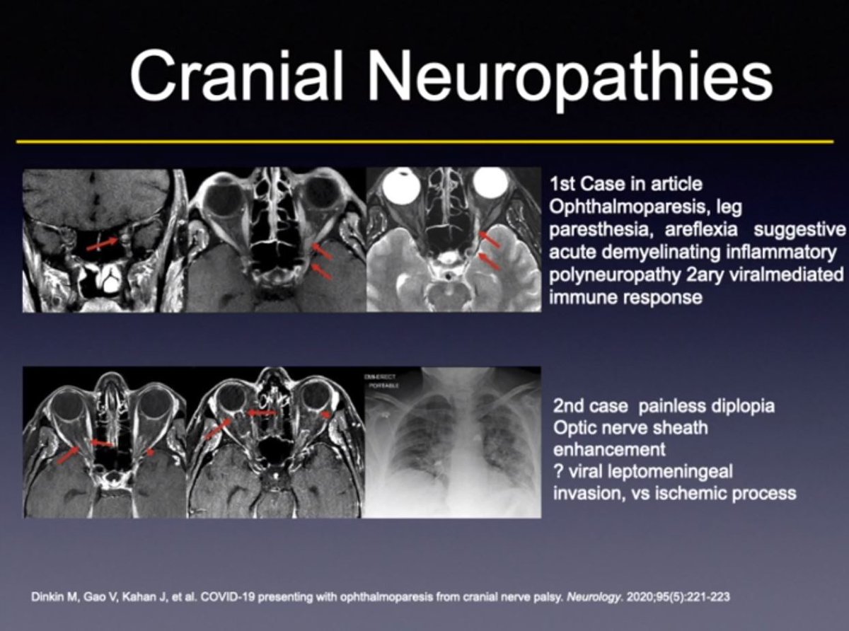 callyrobs's tweet photo. #ASHNR2020 @CfeKirsch Eloquent, beautiful & informative talk on HN HPV, EBV & SARS-CoV-2. COVID 19 - look for CN1 & other cranial neuropathies, various ocular manifestations & secondary bacterial infections. Is parotitis viral or from stasis & ascending bacterial infection? https://t.co/uZZcRKZQg4