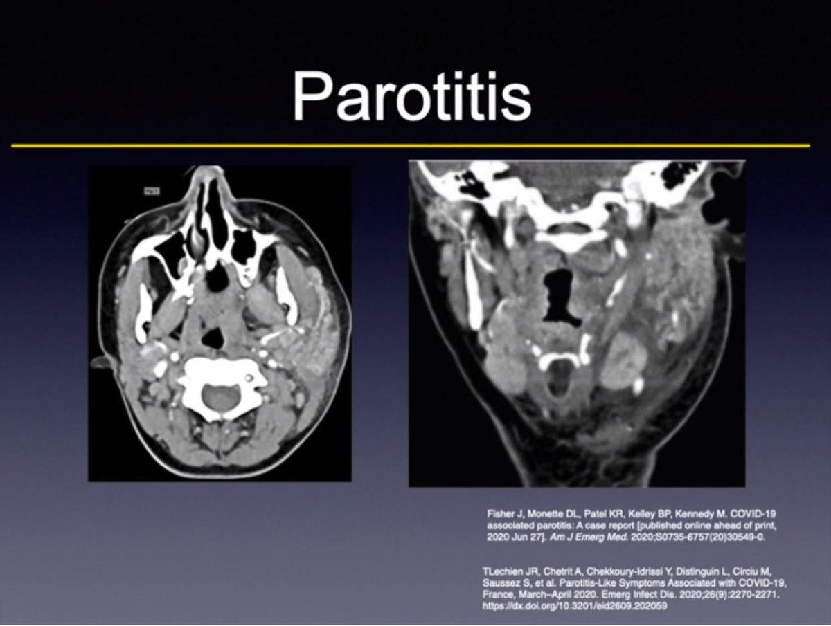 callyrobs's tweet photo. #ASHNR2020 @CfeKirsch Eloquent, beautiful & informative talk on HN HPV, EBV & SARS-CoV-2. COVID 19 - look for CN1 & other cranial neuropathies, various ocular manifestations & secondary bacterial infections. Is parotitis viral or from stasis & ascending bacterial infection? https://t.co/uZZcRKZQg4