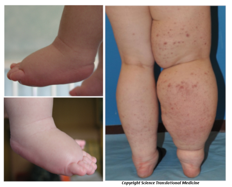 de Duve Institute (@deduveinstitute) on Twitter photo A novel gene involved in lymphedema, ident. by <a href="/MiikkaVikkula/">Miikka. Vikkula</a> &co.
Published in <a href="/ScienceTM/">Science Translational Medicine</a>, this is essential for diagnosis of patients. It opens a novel pathway for new treatments. #Lymphedema is a strongly invalidating chronic disease, affecting over 1M people in Europe. A novel gene involved in lymphedema, ident. by <a href="/MiikkaVikkula/">Miikka. Vikkula</a> &co.
Published in <a href="/ScienceTM/">Science Translational Medicine</a>, this is essential for diagnosis of patients. It opens a novel pathway for new treatments. #Lymphedema is a strongly invalidating chronic disease, affecting over 1M people in Europe.