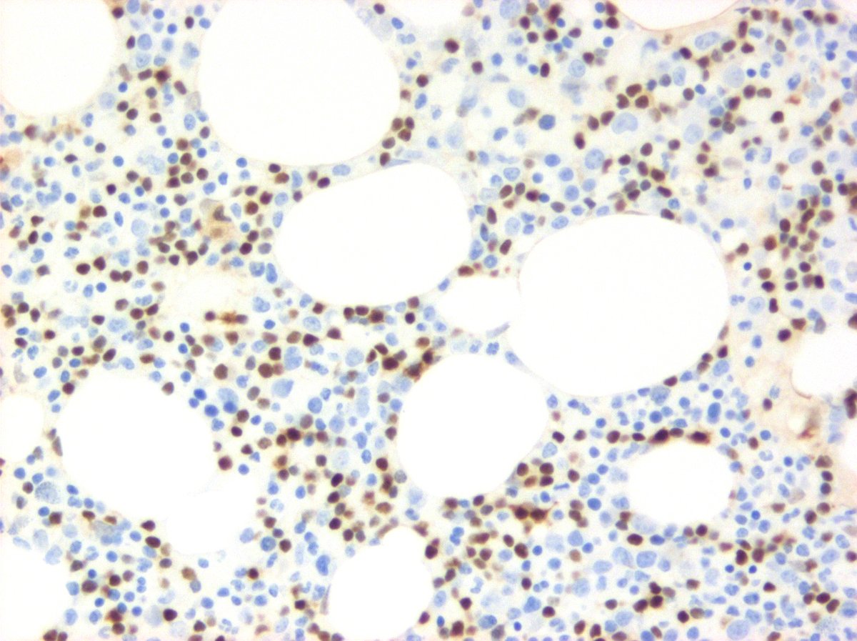 DennisOMalleyMD's tweet photo. A challenge - bone marrow
By flow CD5 and CD10 negative
1) H&amp;E, 2) CD20, 3) cyclin D1, 4) TRAP IHC https://t.co/KTnhzftj8T
