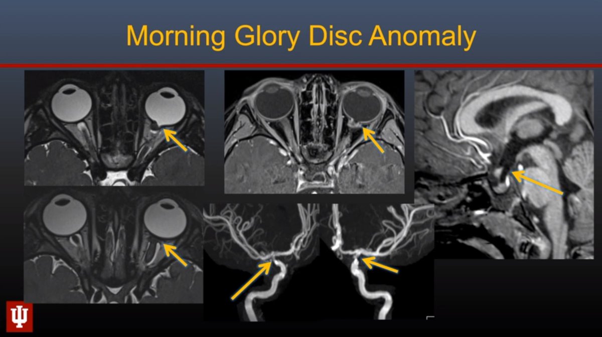 callyrobs's tweet photo. @ASHNRSociety #ASHNR2020 @RadRupa delivers a visual feast with Congenital Orbital Lesions. Tips:
1. Retinal hamartoma (as in TS) in DDX for ocular nodules - not everything is retinoblastoma
2. Look for cephaloceles & arterial steno-occlusive disease (moyamoya) in pts with MGDA. https://t.co/YJFGO5DlO6