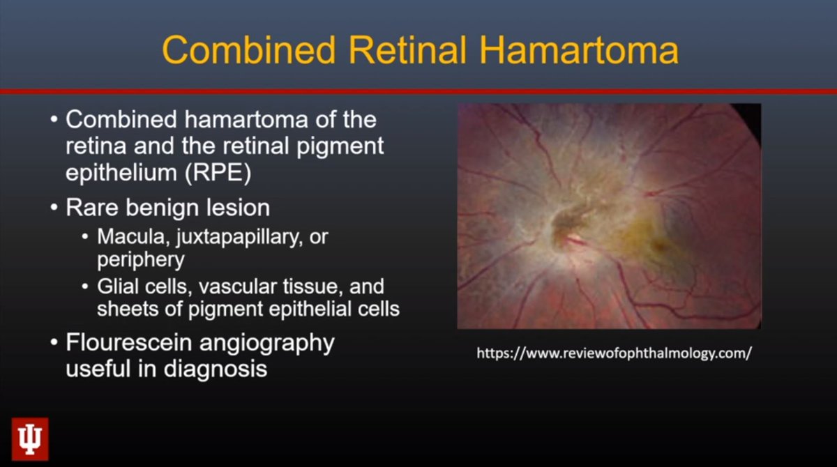 callyrobs's tweet photo. @ASHNRSociety #ASHNR2020 @RadRupa delivers a visual feast with Congenital Orbital Lesions. Tips:
1. Retinal hamartoma (as in TS) in DDX for ocular nodules - not everything is retinoblastoma
2. Look for cephaloceles & arterial steno-occlusive disease (moyamoya) in pts with MGDA. https://t.co/YJFGO5DlO6