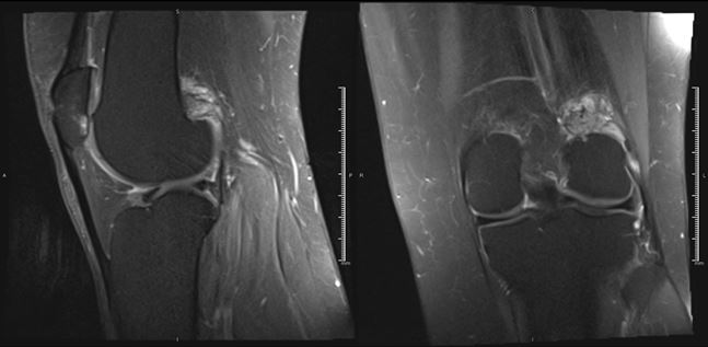BIDMCVIR's tweet photo. Welcome to the #BIDMCVIRCaseFiles! First up: 49M w/ increasing focal post knee pain & lobulated enhancing mass, resection years prior with recurrence. Dx? #IRad Tx options? #MSKinterventions https://t.co/OIqqBnCDg0